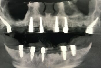 EH Implants scan