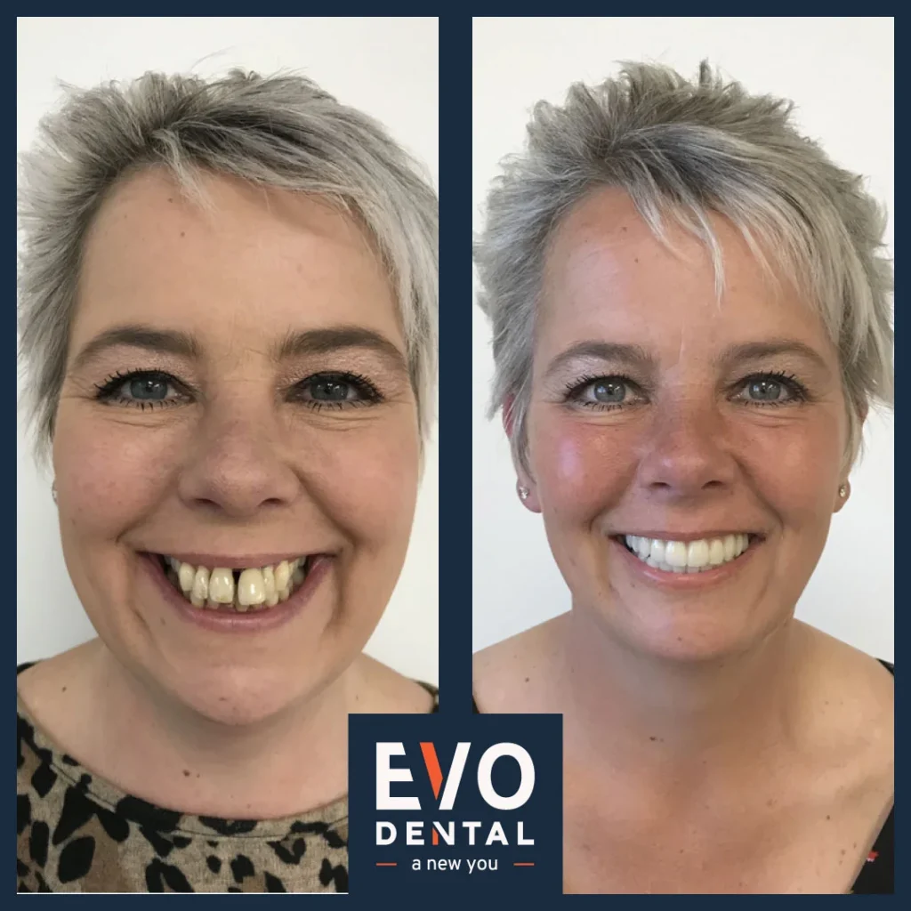 Do dental implants feel natural?