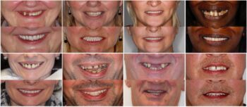 What Are Full Mouth Dental Implants? - Evo Dental