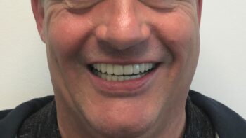 The Functionality And Other Benefits Of Dental Implants - Evo Dental