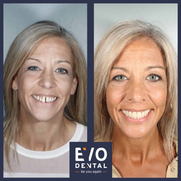 EvoDental before and after - all-on-four
