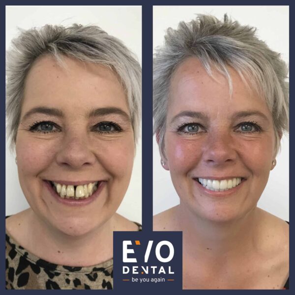 dental implant patient before and after image in Wolverhampton