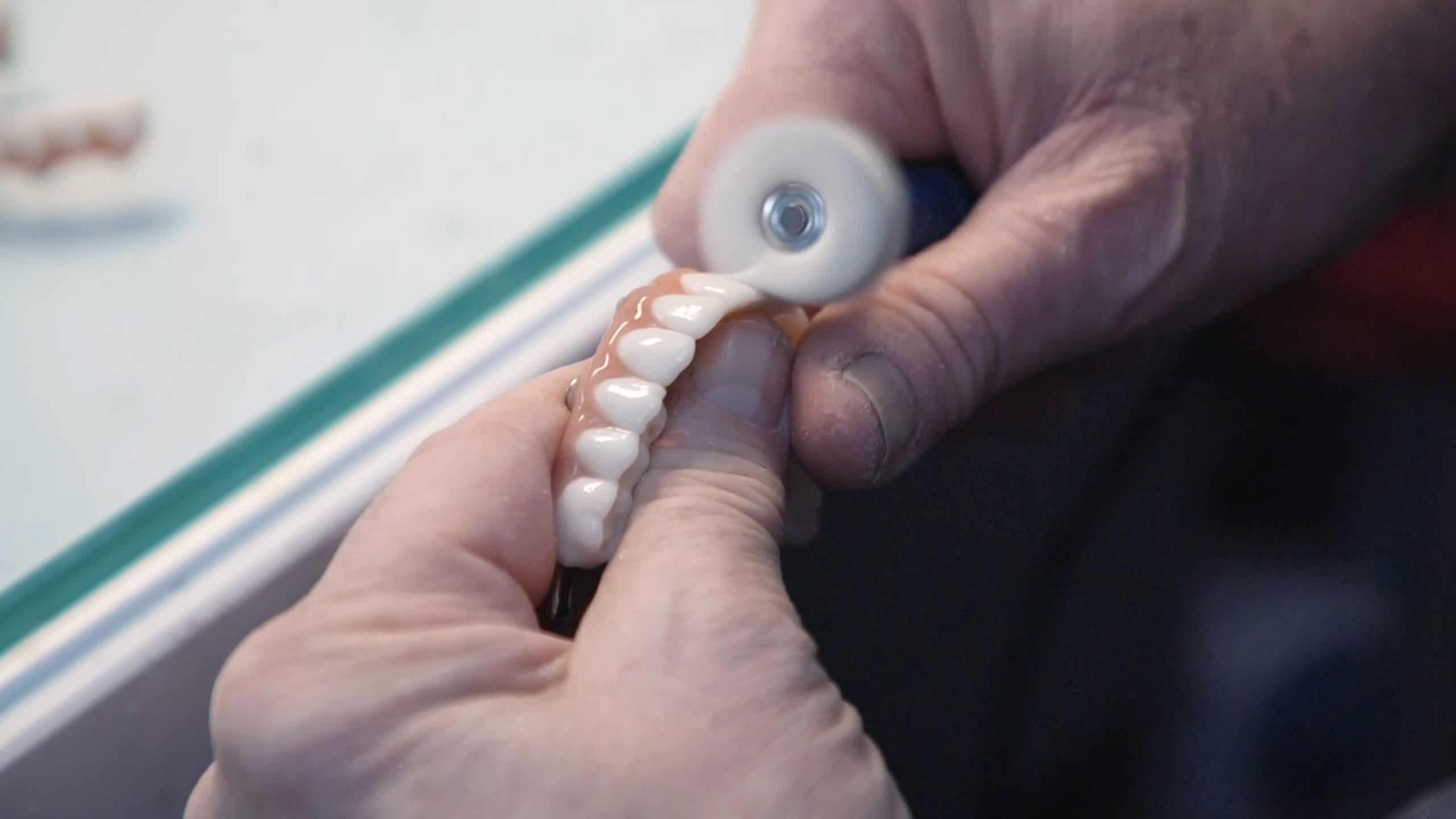 full mouth dental implant prosthetic