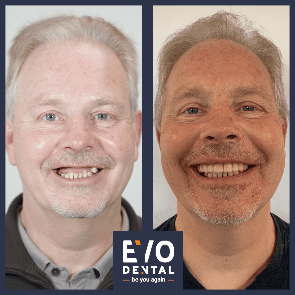 All On 4 Dental Implants London Smile In A Day Implants