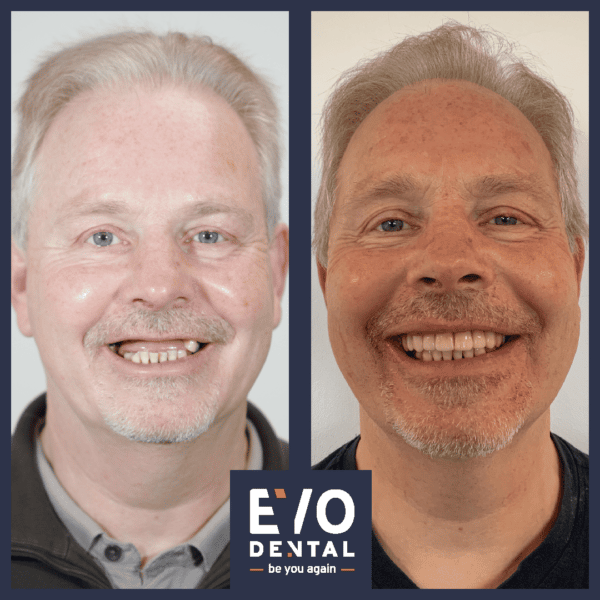 all on four dental implants liverpool - patient before and after 1