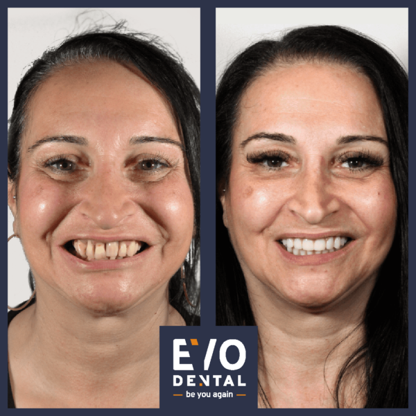 all on four dental implants liverpool - patient before and after 2