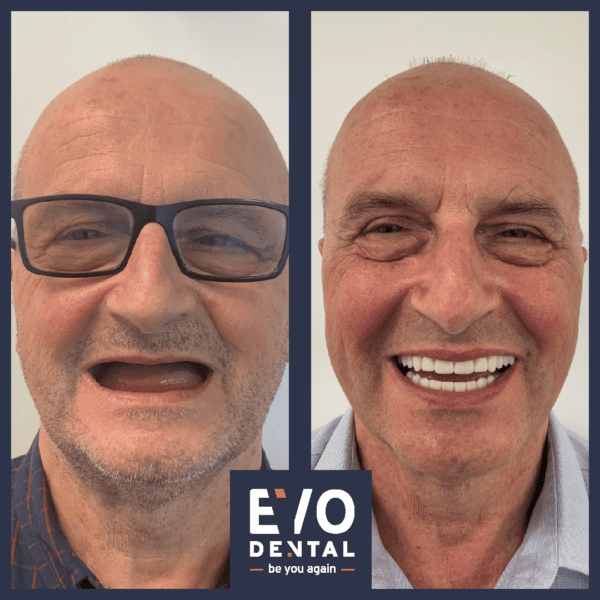all on four dental implants london patient before and after 5