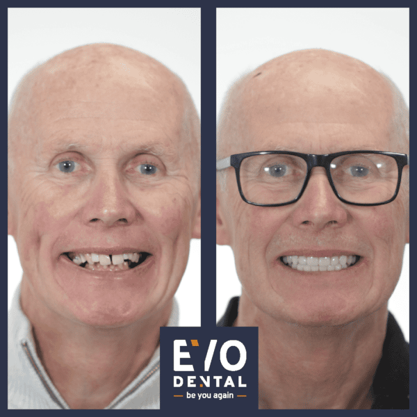 all on four dental implants london patient before and after 6