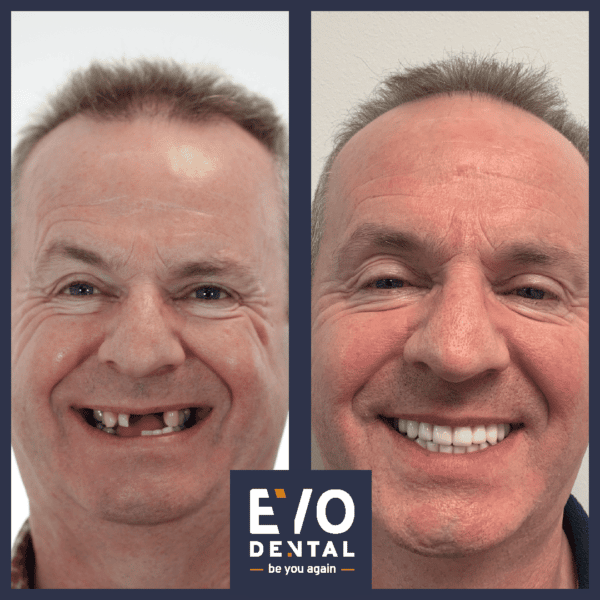 all on four dental implants manchester patient before and after 2