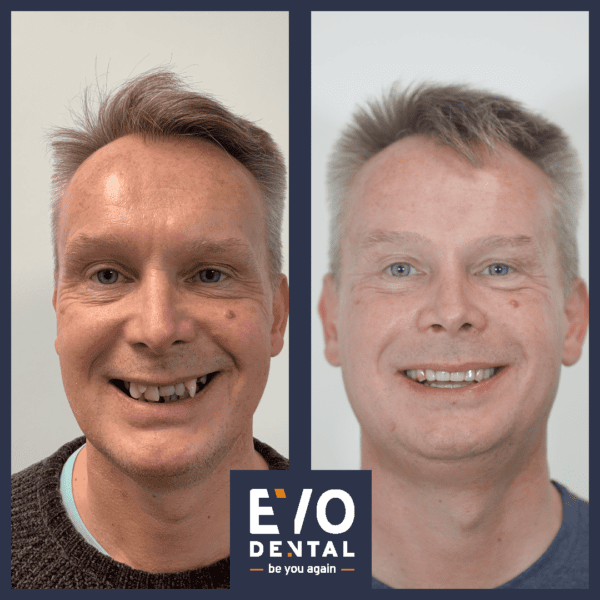all on four dental implants solihull before and after image 2