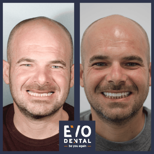 all on four dental implants solihull before and after image 3