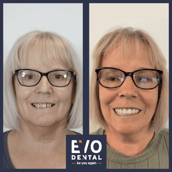 dental implants london patient before and after 2