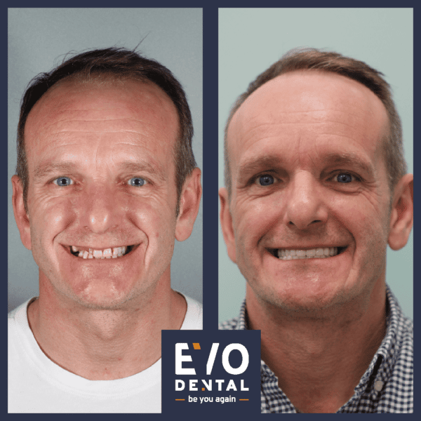 dental implants london patient before and after 6