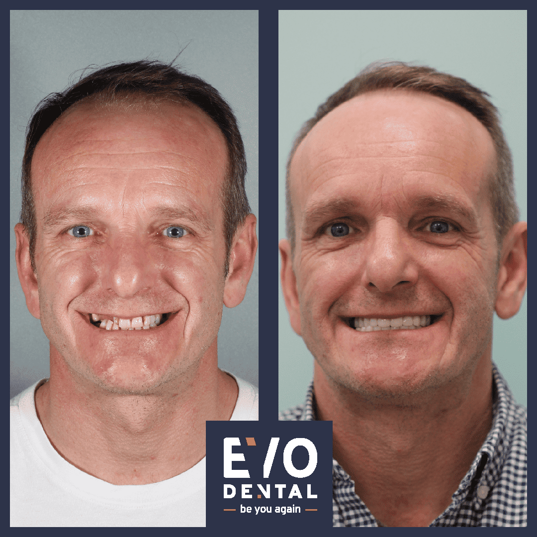 Dental Implants London AllOnFour, Smile In A Day EvoDental
