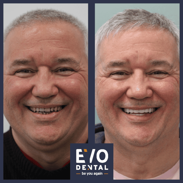 full jaw dental implants manchester patient before and after 3