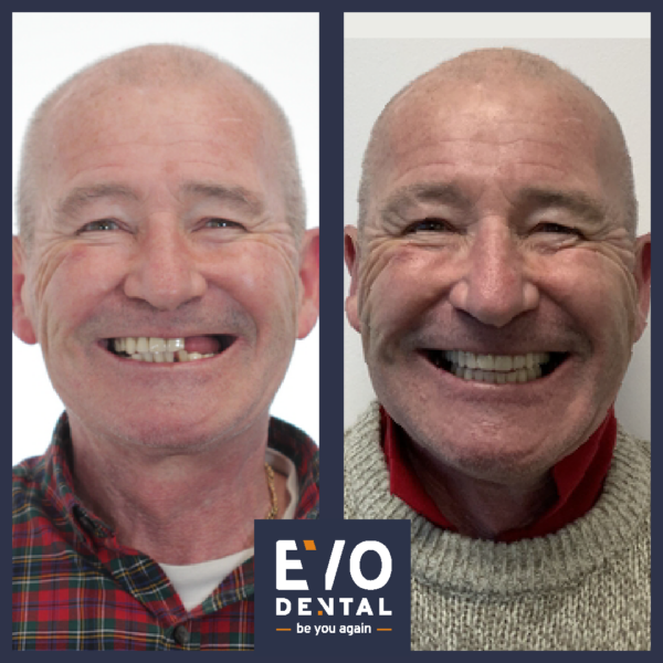full jaw dental implants manchester patient before and after 5