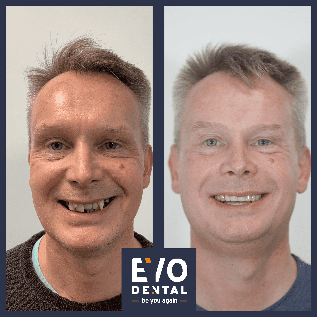 Full Mouth Dental Implants In Liverpool Smile In A Day