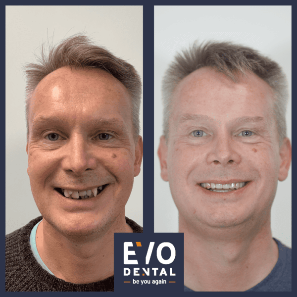 Chipped Teeth repair in London Ontario - London Ontario Dental Clinic