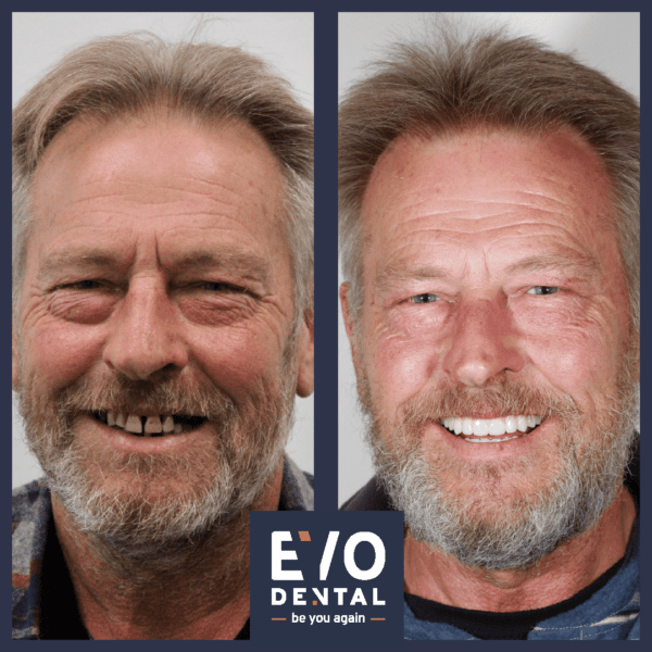 full mouth dental implants solihull patient before and after 2