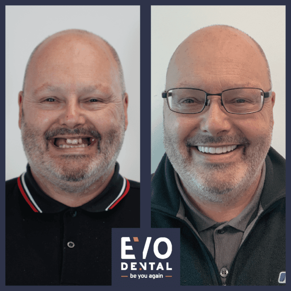 leeds dental implants - patient before and after 2