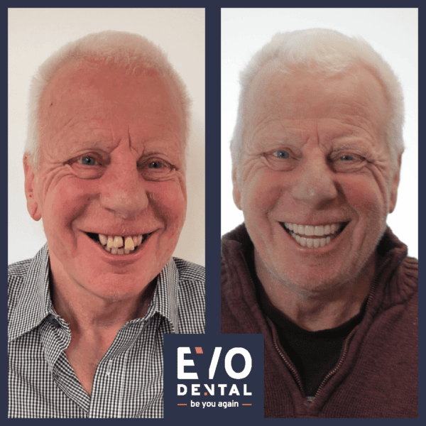 smile in a day dental implants london patient before and after 2