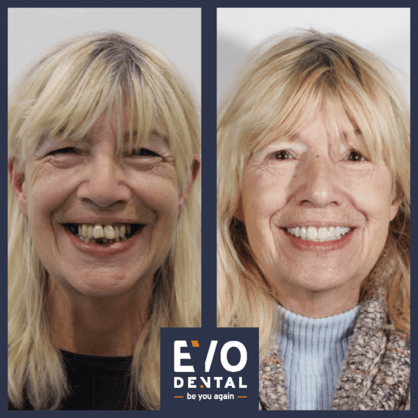 smile in a day dental implants london patient before and after 6