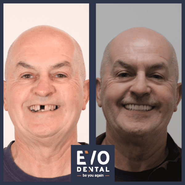smile in a day solihull patient before and after 2