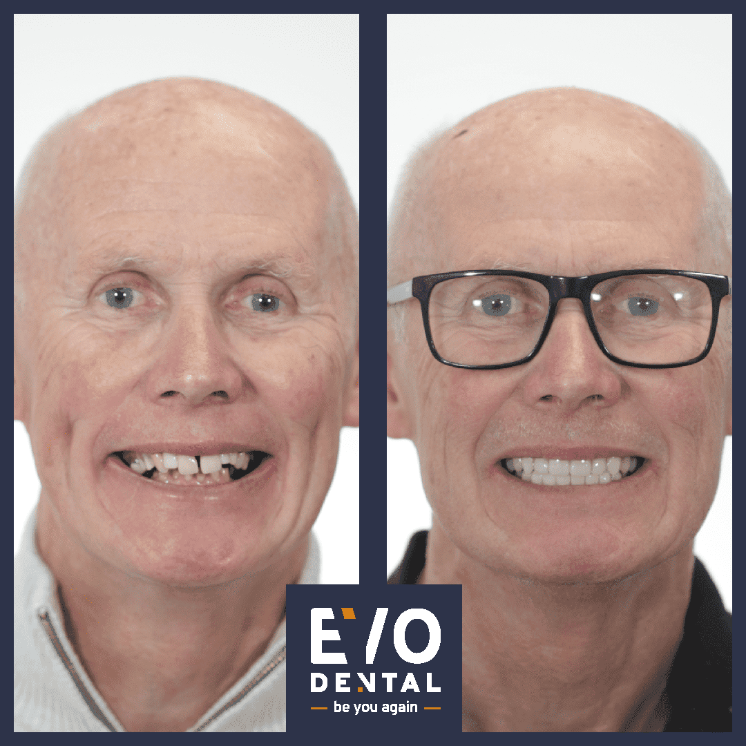 Full Mouth Dental Implants Wolverhampton EvoDental