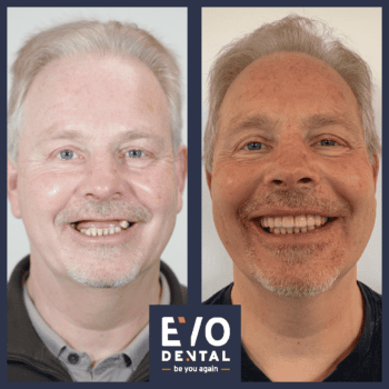 all on four dental implants leeds 3