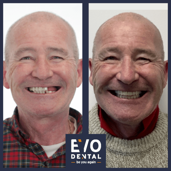 EvoDental - Worcester Dental Implants