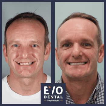 denture alternative leeds 4