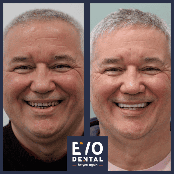 Worcester Dental Implants - EvoDental