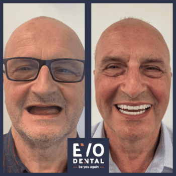 full mouth dental implants leeds 2