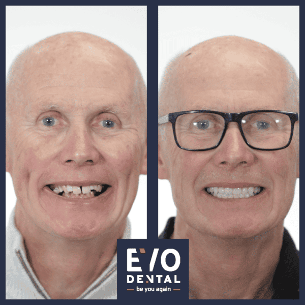 Dental Implants in Worcester