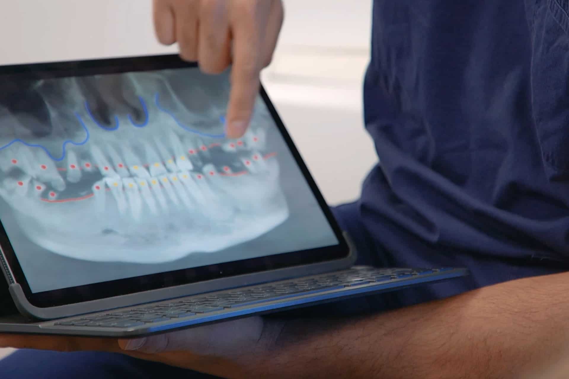 How Many Teeth Can You Support With Dental Implants? Evo