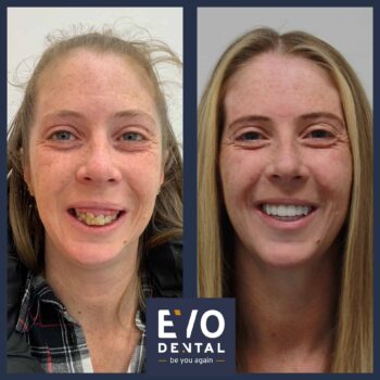 Rachel: Before and After - EvoDental