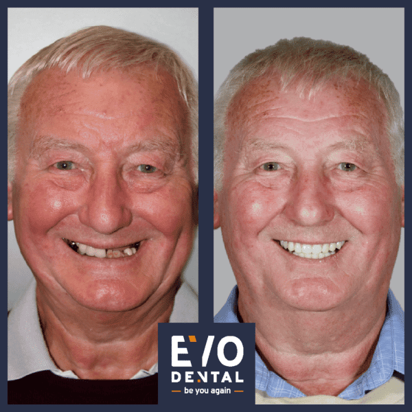 Dental Implants Sheffield - EvoDental