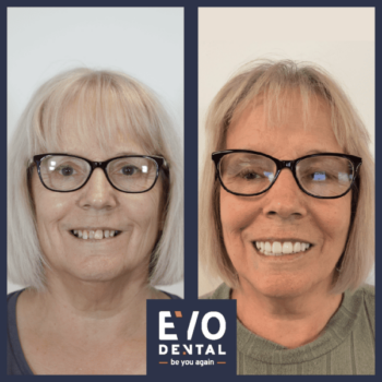 Dental Implants Sheffield With EvoDental