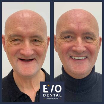 Patient Transformation - EvoDental