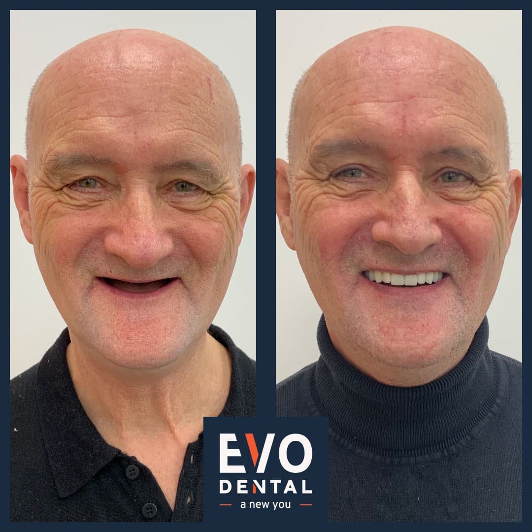 Patient Transformation - EvoDental