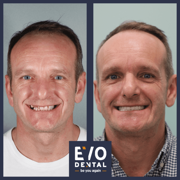 Dental Implants Medway - EvoDental