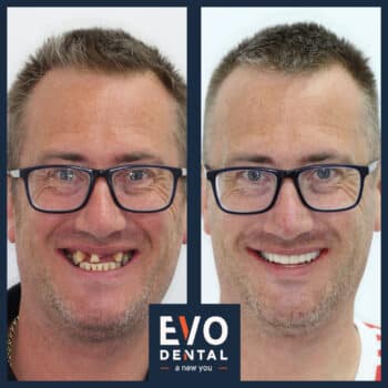 smile-in-a-day-dental-implant-before-and-after-1