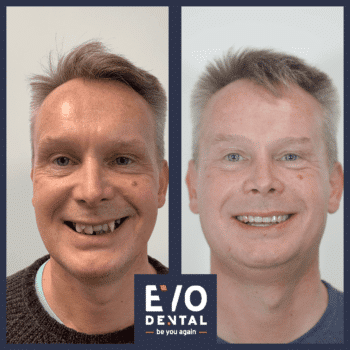 smile-in-a-day-dental-implant-before-and-after-10