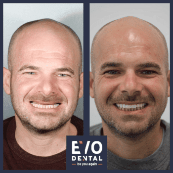 smile-in-a-day-dental-implant-before-and-after-16