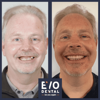 smile-in-a-day-dental-implant-before-and-after-17