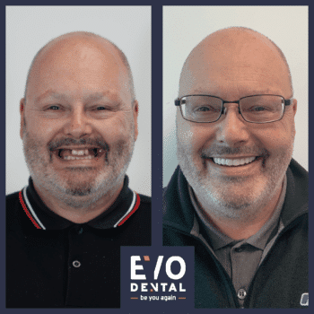 smile-in-a-day-dental-implant-before-and-after-7