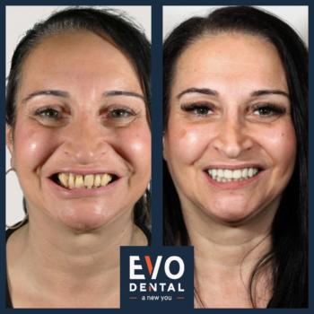 smile-in-a-day-dental-implant-before-and-after-8