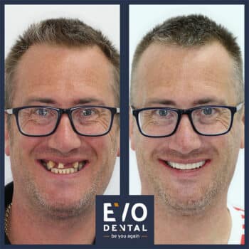 Dental Implants Cost - Before & After Photos