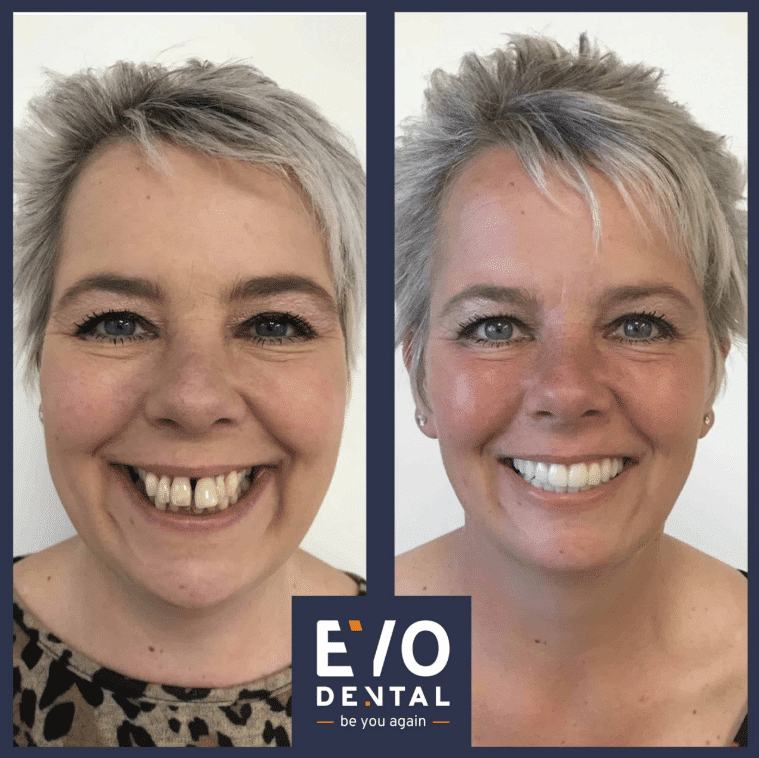 Dental Implants Aberdeen