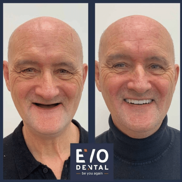 Aberdeen Dental Implants